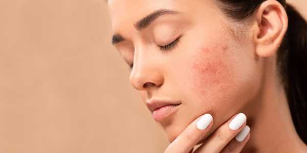 5 Skin Care Tips That Really Work to Prevent Acne Scars